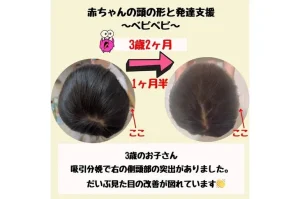 赤ちゃんの【頭蓋骨矯正】⁉あなたのお子さん頭の形正常ですか❓